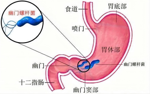 幽门螺杆菌_副本.png
