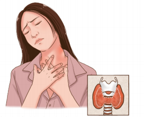 甲状腺癌.png