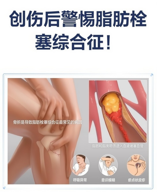 脂肪栓塞综合征_副本.png